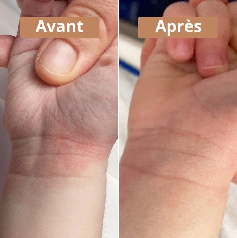 Avant et après utilisation de la crème au beurre de karité sur le poignet