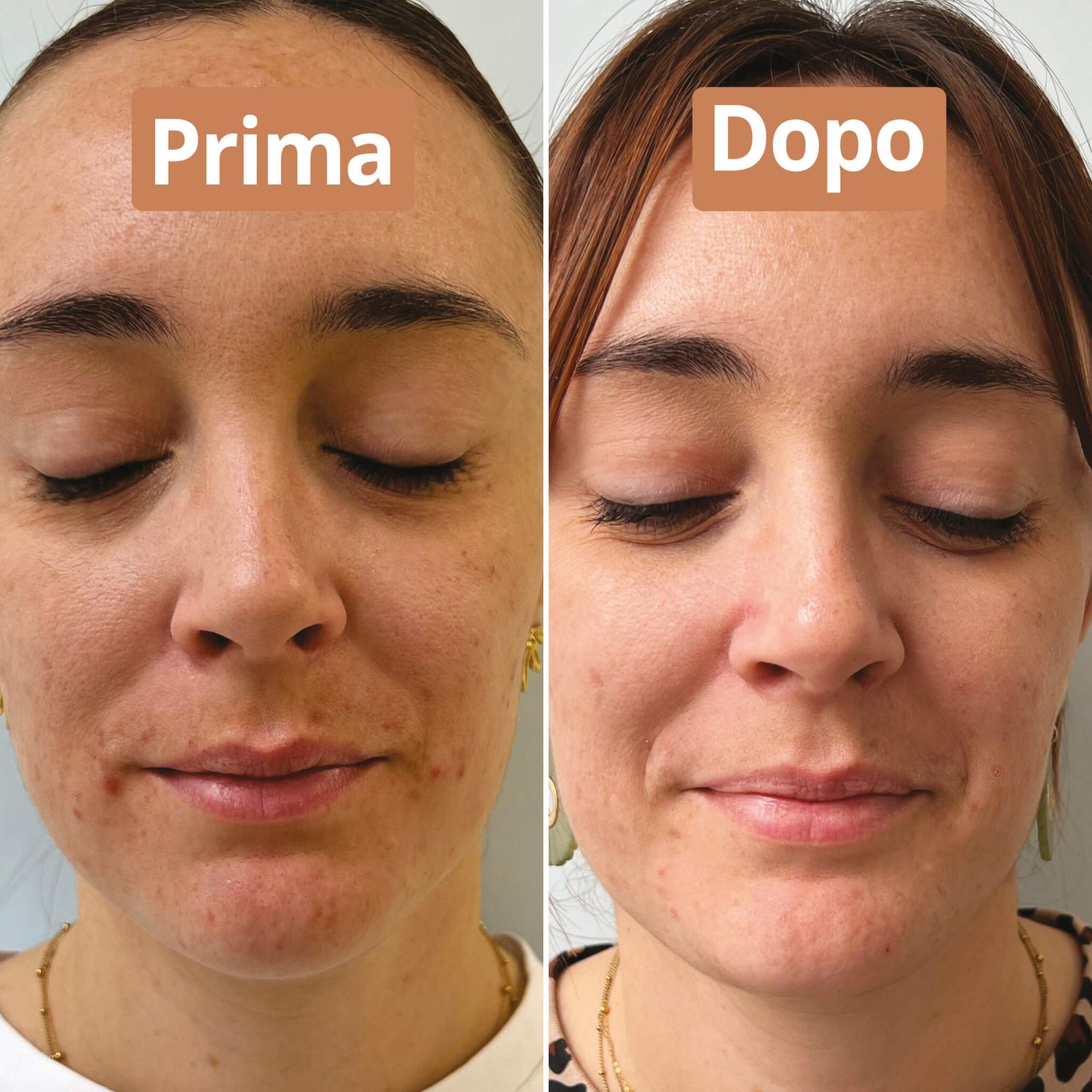 Prima e dopo aver applicato il siero purificante Comme Avant